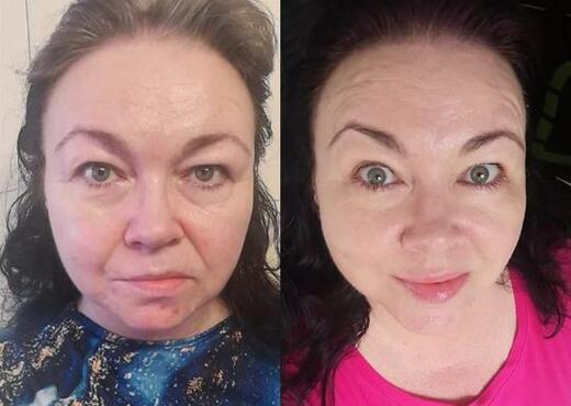 Omlazení přístrojem HIFU aneb Ultherapy SMAS