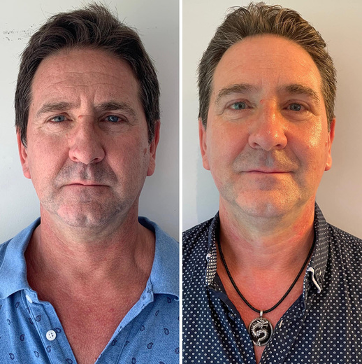 NOVÝ přístroj HIFU 4D - 12X INTENZÍVNĚJŠÍ obličej MUŽI