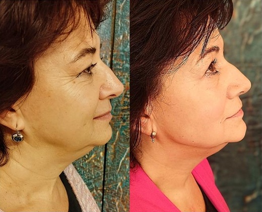 Thermage NOVÝ STROJ - o 40% silnější 900 výstřelů LIFTING OVÁLU