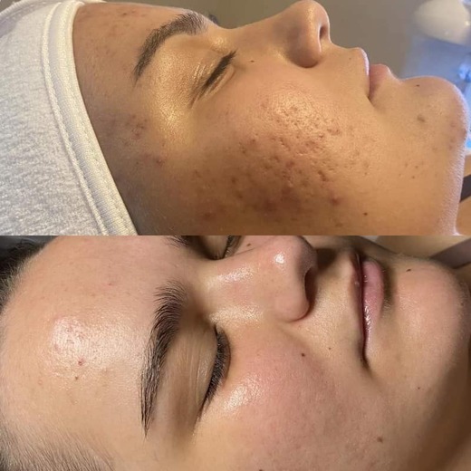 BB GLOW a Mikrojehličkování v jedné proceduře