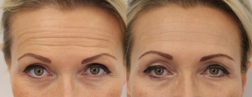 Omlazení přístrojem Thermage 4. generace