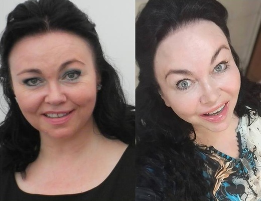 NOVÝ P. TROJITÉ OŠETŘENÍ ULTHERAPY HIFU - obličeje a podbradku