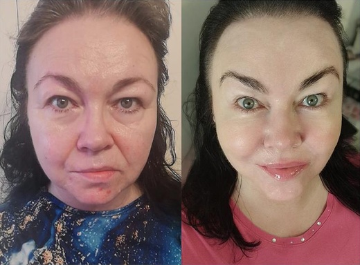 DVOJITÉ OŠETŘENÍ ULTHERAPY HIFU - obličeje a podbradku
