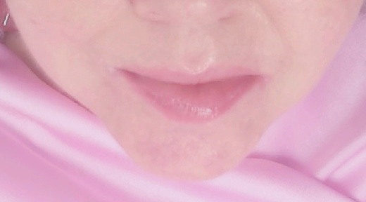 Vyplnění RTŮ perem HYALURON PEN s  kys. Hyaluron 2 ml JUVEDERM