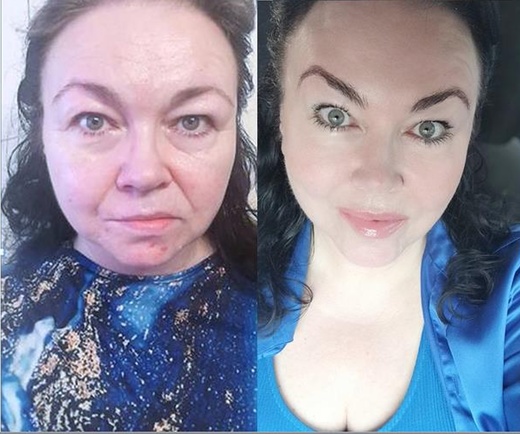 Thermage NOVÝ STROJ - LIFTING DOLNÍHO OVÁLU OBLIČEJE