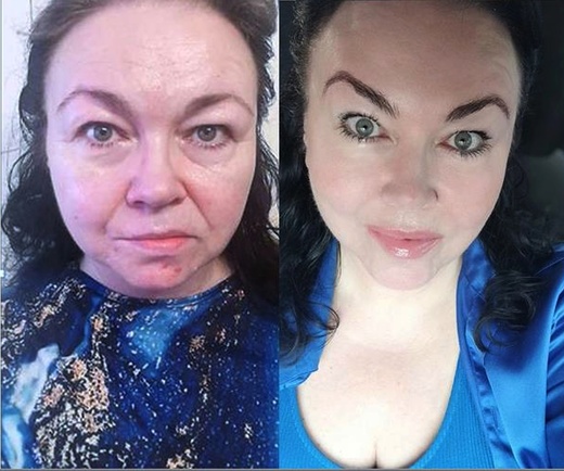 Thermage NOVÝ STROJ - LIFTING OVÁLU OBLIČEJE