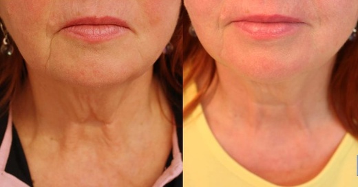 Thermage NOVÝ STROJ -  o 40% silnější 600 výstřelů LIFTING OVÁLU