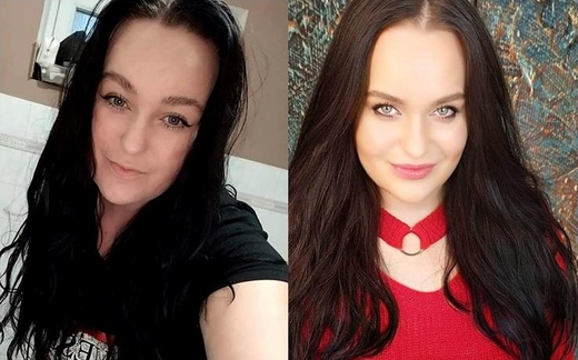 Vyplnění RTŮ perem HYALURON PEN s  kys. hyaluronová 2ml