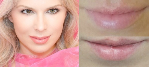 3D RTY - Omlazení Thermage, Mikrojehličkování a výplně kys. hyal