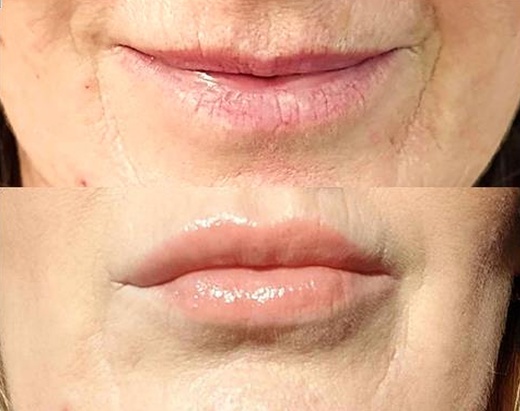 2D RTY - Omlazení Thermage a výplň kys. hyaluron. Hyaluron Pen