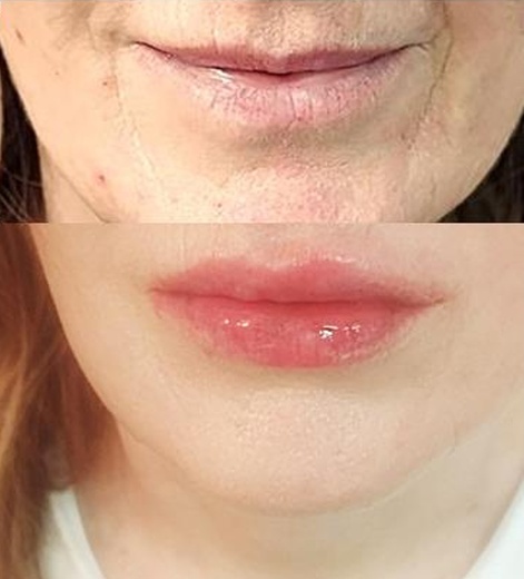 2D RTY - Omlazení Thermage a výplň kys. hyaluron. Hyaluron Pen