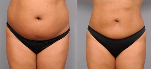 Zeštíhlení těla a dolní poloviny obličeje přístrojem LIPOSONIX