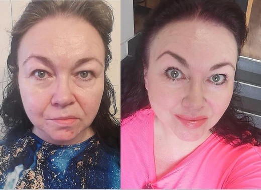 Výplně nosoretnih rýh kyselinou hyaluronovou JUVEDERM