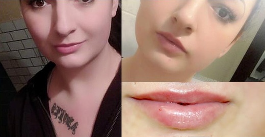 Balíček KRÁSNÉ RTY = Mikrojehličkování rtů a výplň Hyaluron Pen