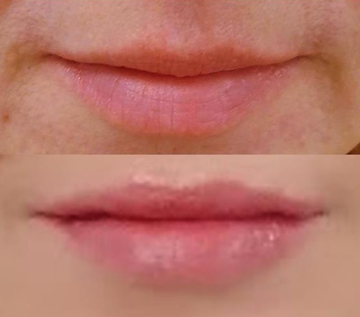 Vyplnění RTŮ perem HYALURON PEN s  kys. Hyaluron 2ml STYLAGE M
