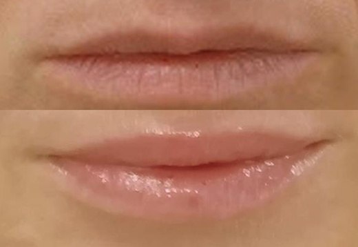Vyplnění RTŮ perem HYALURON PEN s  kys. Hyaluron 1ml 3D kyselina