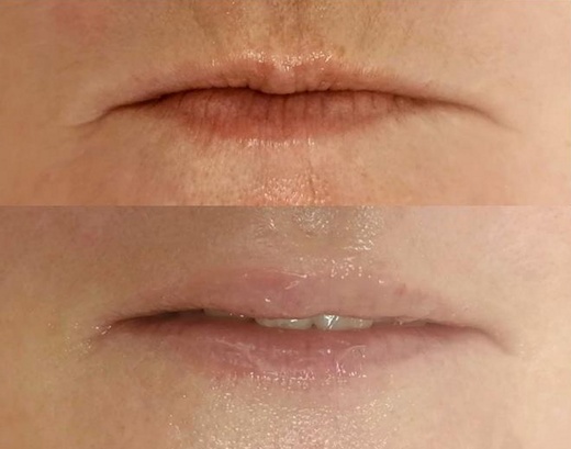 Vyplnění RTŮ perem HYALURON PEN s  kys. Hyaluron 1ml JUVEDERM