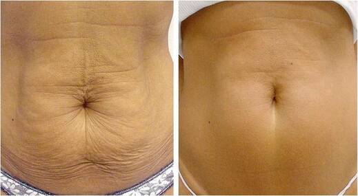 Neinvazivní LIPOSUKCE DUO Therapy 2 stroje THERMAGE a LIPOSONIX
