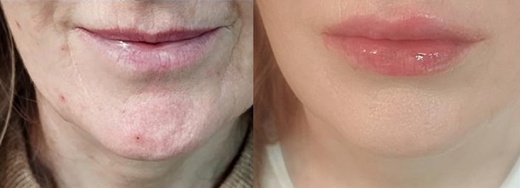 THERMAGE OMLAZENÍ 400 "výstřelů" + Lifting Oválu + Výplně rtů