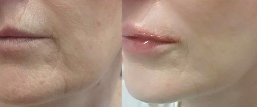 Žena 48 let před a po Dvojitém omlazená a výplních rtů Z BOKU.jp