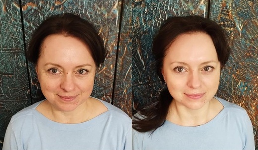 Thermage NOVÝ STROJ -  40% silnější 1400 výstřelů aLIFTING OVÁLU