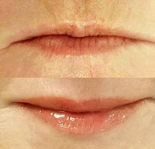 4D RTY - Omlazení Thermage, Mikrojehličkování, Výplně a Tetování