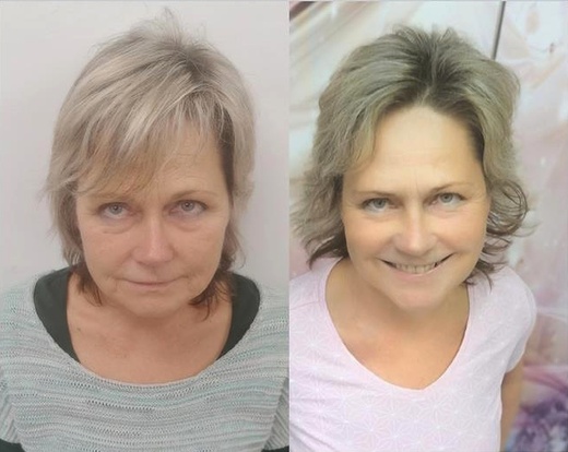 Žena 58 let před a po 1. omlazení přístroje Thermage v jeden den