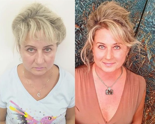 Žena 59 let před a po Balíčku 4D s liftingem Oválu.jpg