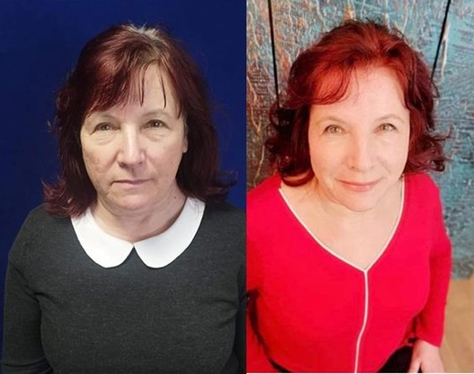 Thermage NOVÝ STROJ - EXPRESNÍ OMLAZENÍ