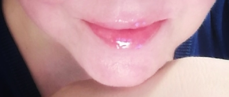 Já výplně 2,5 ml.jpeg