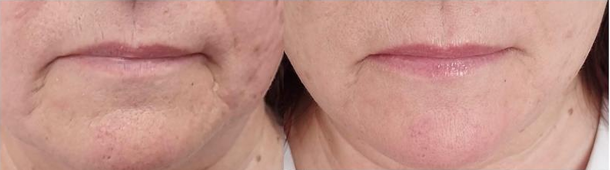 Před a po liftingu Oválu středním VEDLE SEBE.jpg