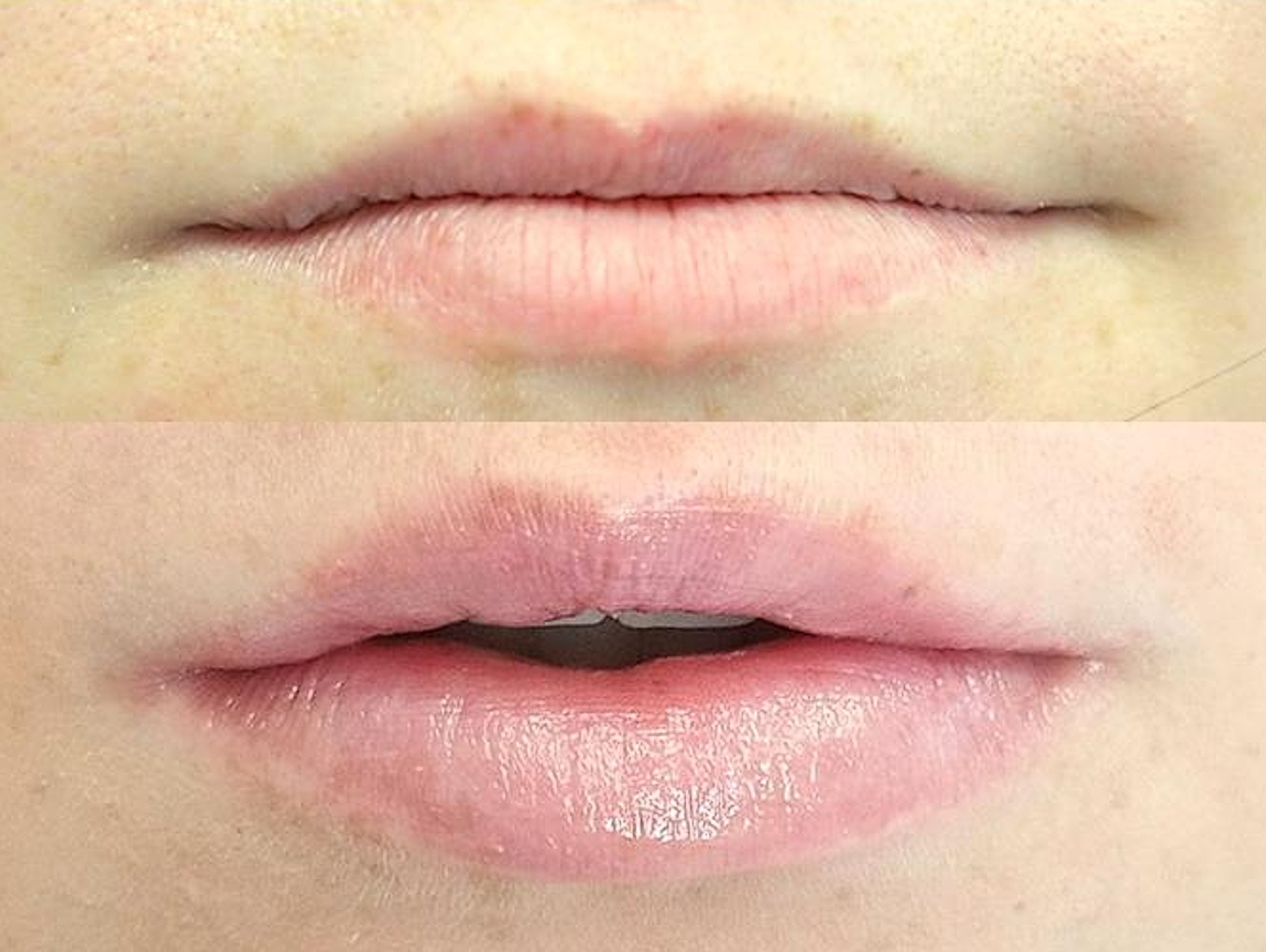 Před a po výplni rtů 2,3 ml
