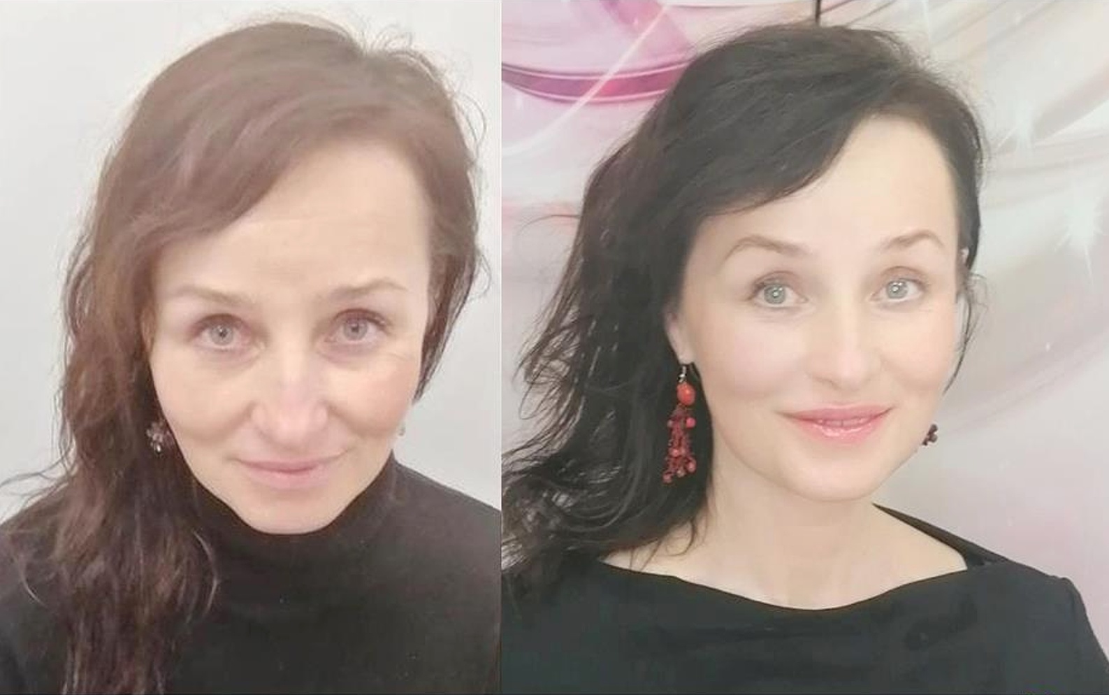 Světlana před a po Thermage