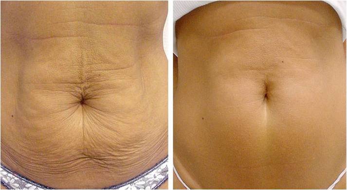Thermage-CPT-abdomen-before-and-after3.jpg