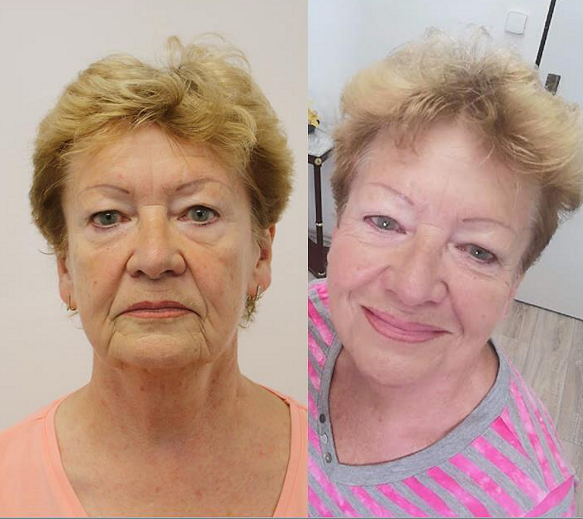 Žena 73 let po 2 omlazeních Thermage
